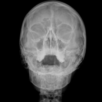 2-sinus-pa